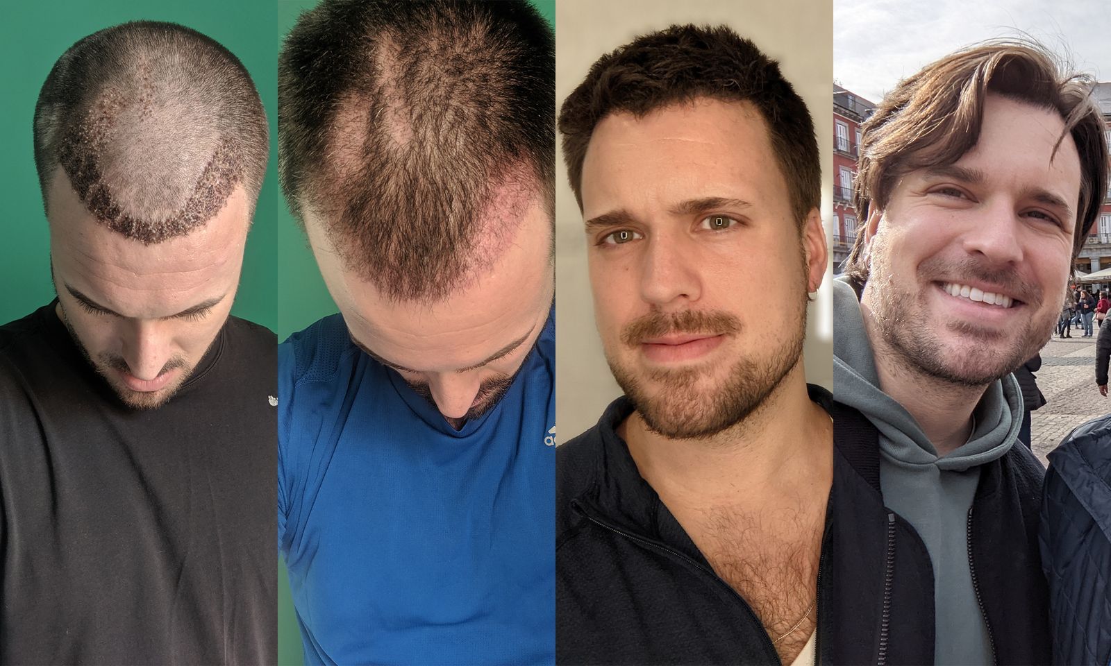 Restore Your Look with NYC Hair Replacement