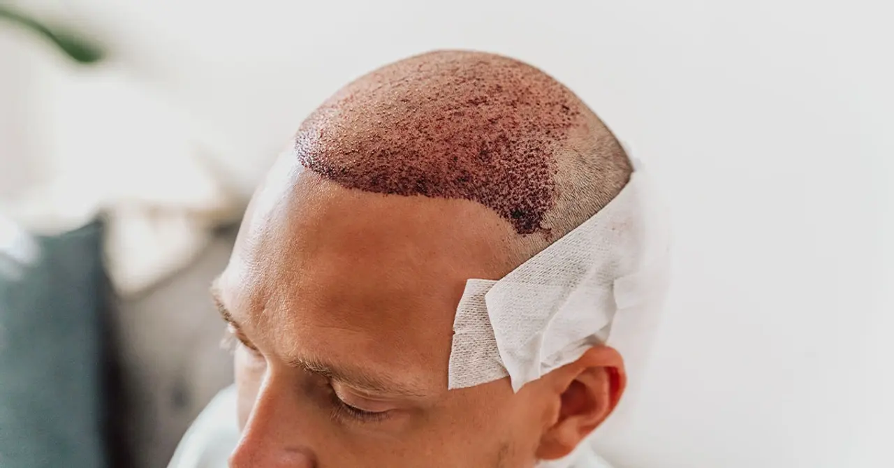 Hair transplant Turkey: Discover the Best Hair Clinic